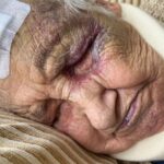 Old woman sleeping and looking hurt and bruised
