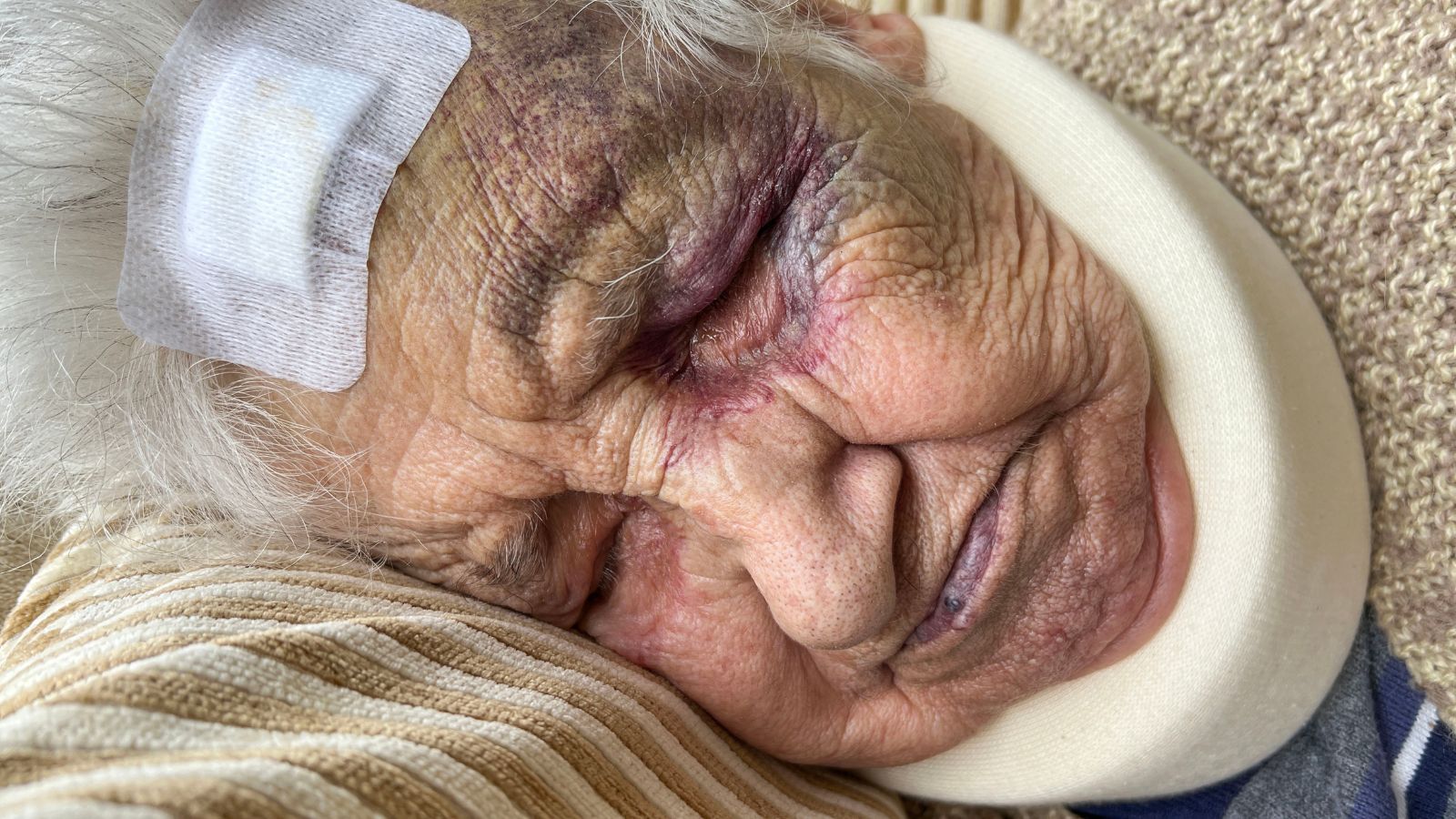 Old woman sleeping and looking hurt and bruised